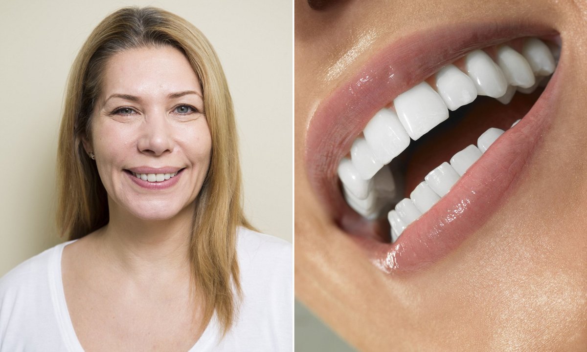 Виниры комплект Snap-on smile