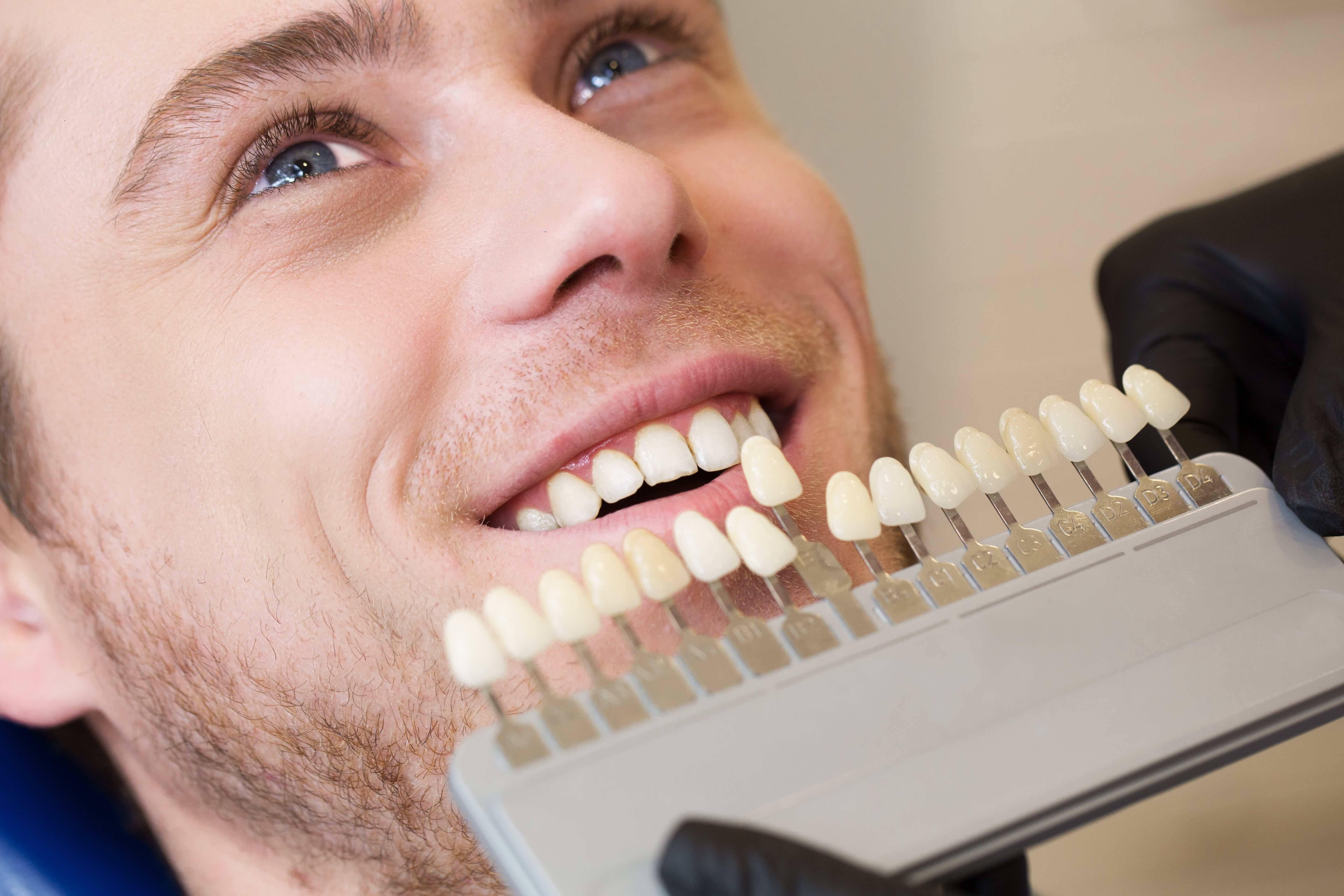 Стоматологическое отбеливание зубов. Красивые зубы. Идеальные зубы. Красивый цвет зубов.